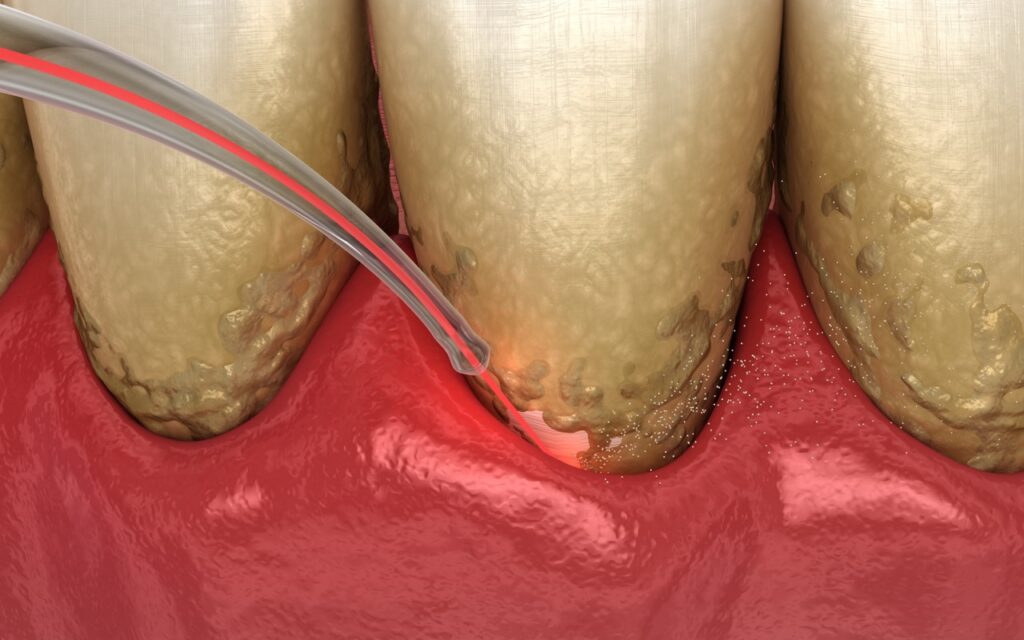 Laser Dental Treatments in Orange County: Why Patients Are Choosing This Modern, Gentle Approach 2 Laser Dental Treatments in Orange County: Why Patients Are Choosing This Modern, Gentle Approach