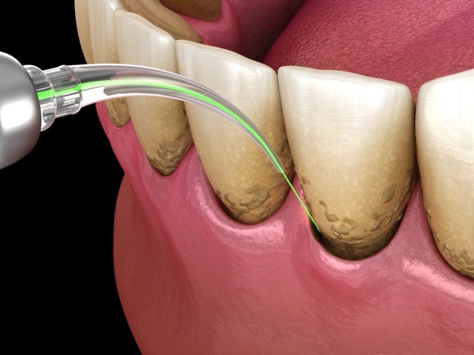 Laser Dental Treatments in Orange County: Why Patients Are Choosing This Modern, Gentle Approach 4 Laser Dental Treatments in Orange County: Why Patients Are Choosing This Modern, Gentle Approach