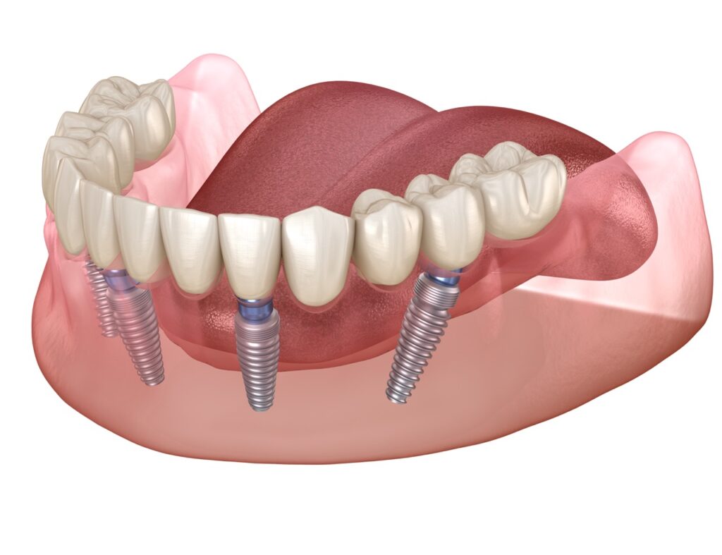 Are You a Candidate for an All-on-4 Bridge? Everything You Need to Know 1 all on 4 3d image