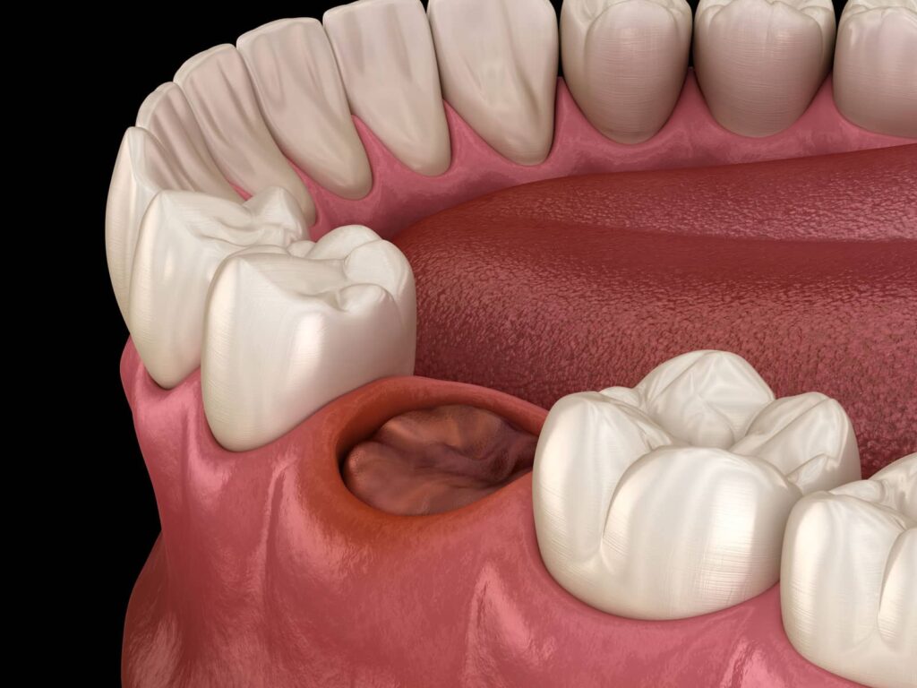 What Does a Dry Socket Look Like? A Holistic Approach to Post-Extraction Care 1 What Does a Dry Socket Look Like? A Holistic Approach to Post-Extraction Care