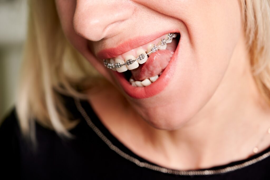 What Is Adult Orthodontics? A Holistic Dentist's Guide to Straighter Teeth at Any Age 1 Woman smiling with Adult Orthodontics