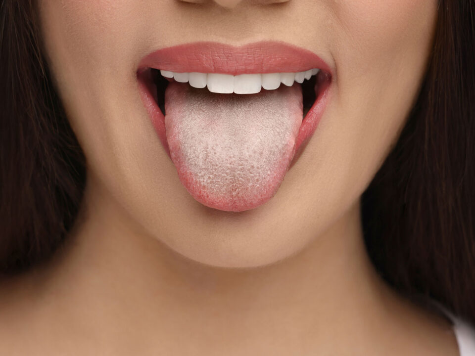 What Is Leukoplakia? A Holistic Dentist’s Guide to White Patches in Your Mouth 2 What Is Leukoplakia? A Holistic Dentist’s Guide to White Patches in Your Mouth