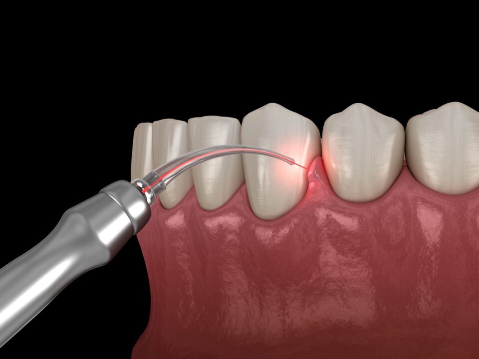 What Is the LANAP Procedure? A Holistic Approach to Gum Disease Treatment 8 What Is the LANAP Procedure? A Holistic Approach to Gum Disease Treatment