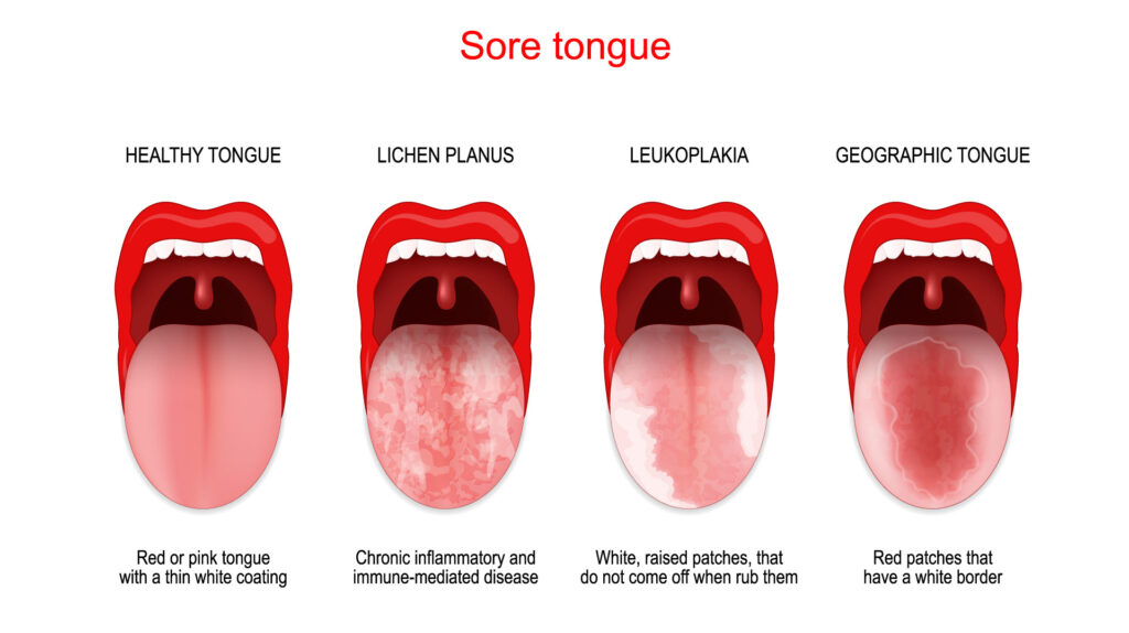 What Is Leukoplakia? A Holistic Dentist’s Guide to White Patches in Your Mouth 2 What Is Leukoplakia? A Holistic Dentist’s Guide to White Patches in Your Mouth