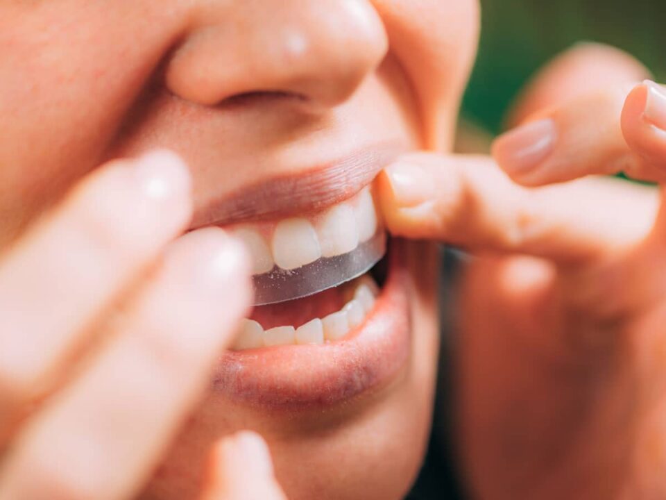 Do Teeth Whitening Strips Work? The Biological Dentist's Honest Answer 4 Do Teeth Whitening Strips Work? The Biological Dentist's Honest Answer