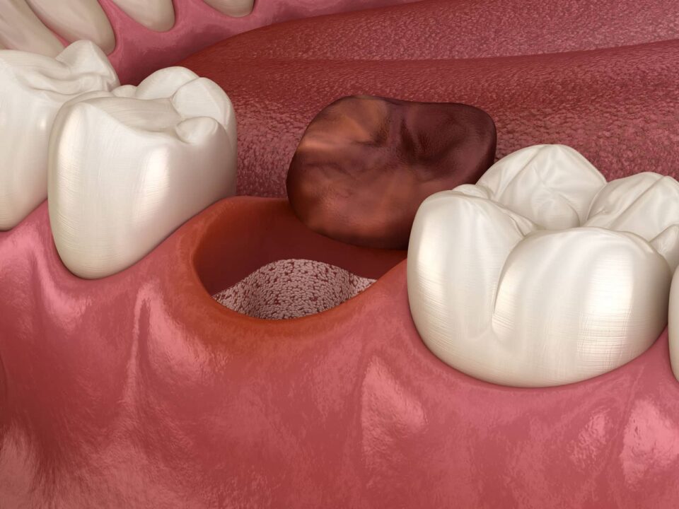 What Does a Dry Socket Look Like? A Holistic Approach to Post-Extraction Care 16 What Does a Dry Socket Look Like? A Holistic Approach to Post-Extraction Care