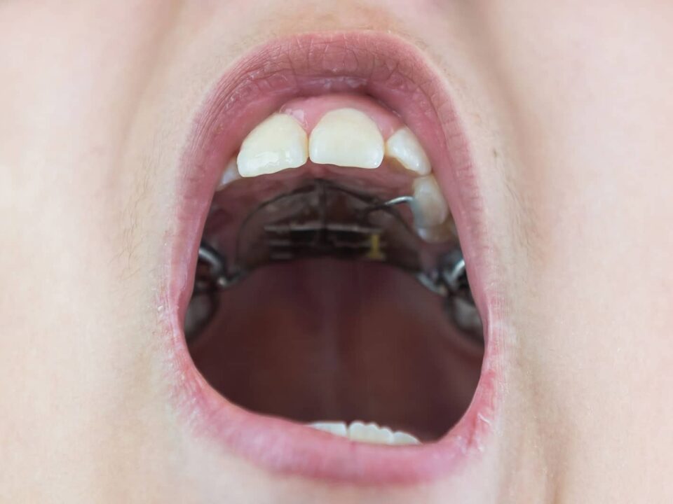What Is an Expander for Braces? Signs You May Need One 2 What Is an Expander for Braces?