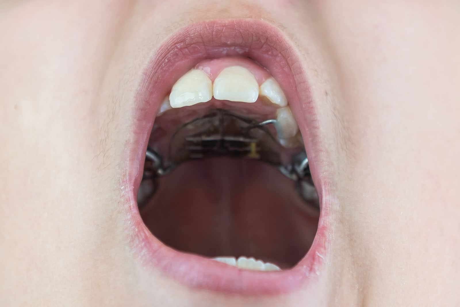 What Is an Expander for Braces?
