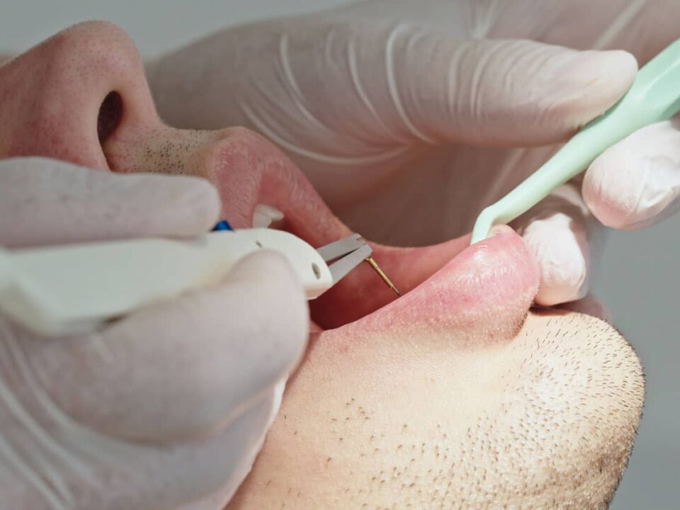Can a Gum Graft Fix My Receding Gums? The Honest Answer from Aria Dental Care 6 Can a Gum Graft Fix My Receding Gums? The Honest Answer from Aria Dental Care