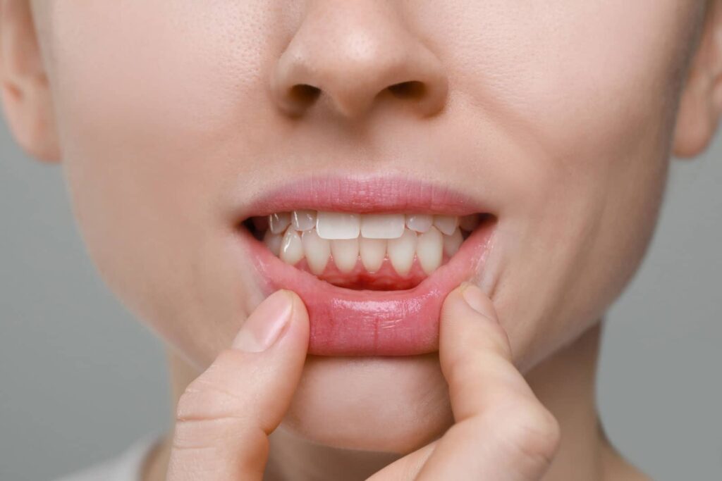 Can a Gum Graft Fix My Receding Gums? The Honest Answer from Aria Dental Care 1 Can a Gum Graft Fix My Receding Gums? The Honest Answer from Aria Dental Care