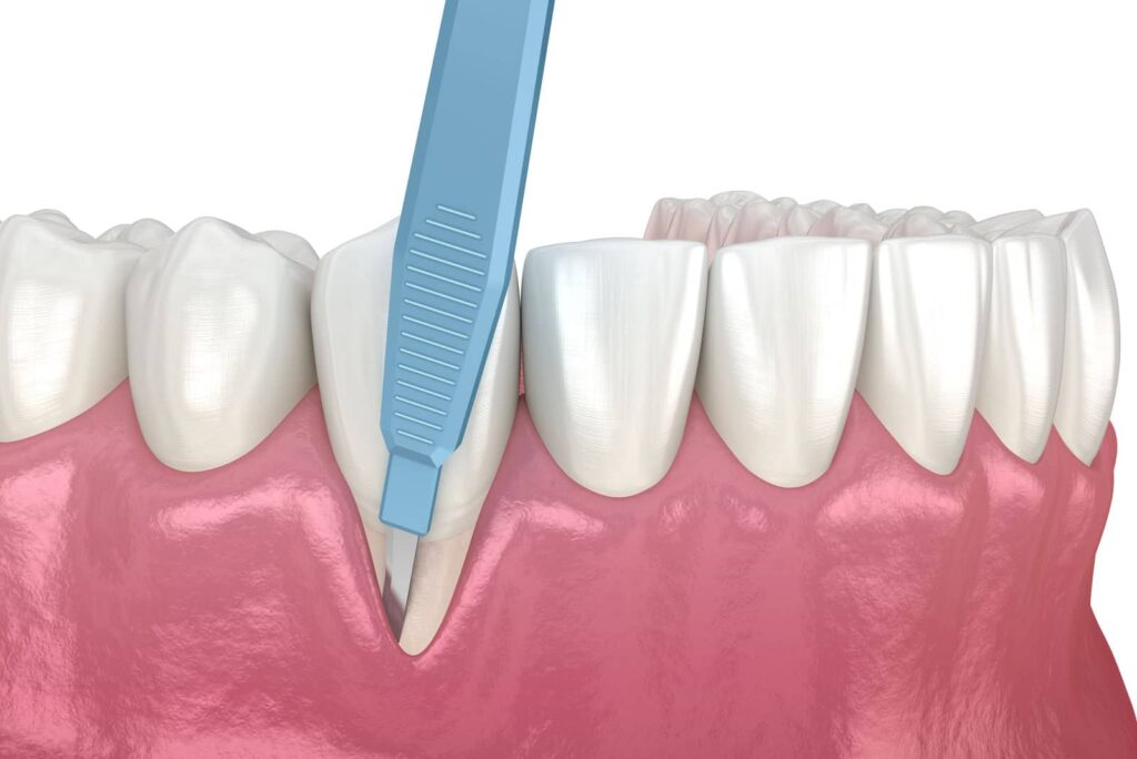 Can a Gum Graft Fix My Receding Gums? The Honest Answer from Aria Dental Care 2 Can a Gum Graft Fix My Receding Gums? The Honest Answer from Aria Dental Care