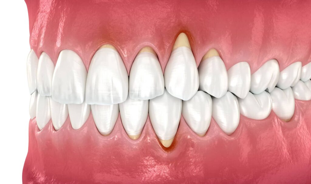 Can a Gum Graft Fix My Receding Gums? The Honest Answer from Aria Dental Care 3 Can a Gum Graft Fix My Receding Gums? The Honest Answer from Aria Dental Care