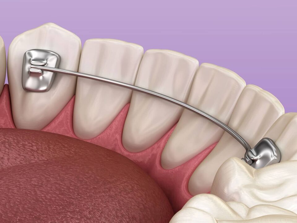 What Your Dental Orthodontic Retainer Could Be Doing to Your Body: A Biological Dentist Explains 6 What Your Dental Orthodontic Retainer Could Be Doing to Your Body: A Biological Dentist Explains
