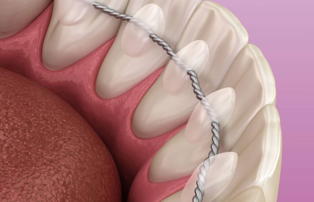 What Your Dental Orthodontic Retainer Could Be Doing to Your Body: A Biological Dentist Explains 1 What Your Dental Orthodontic Retainer Could Be Doing to Your Body: A Biological Dentist Explains