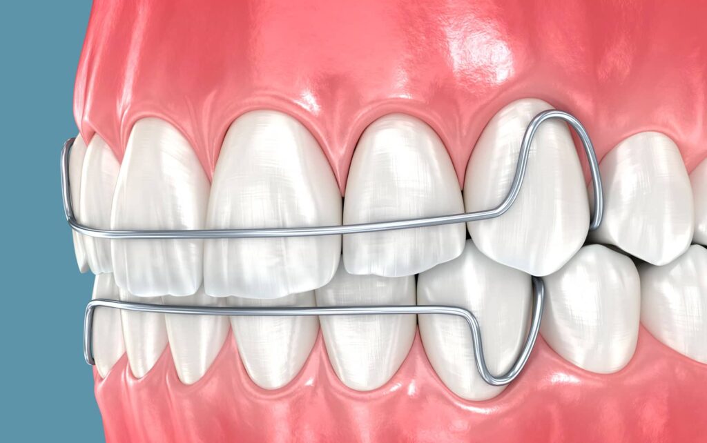 What Your Dental Orthodontic Retainer Could Be Doing to Your Body: A Biological Dentist Explains 2 What Your Dental Orthodontic Retainer Could Be Doing to Your Body: A Biological Dentist Explains