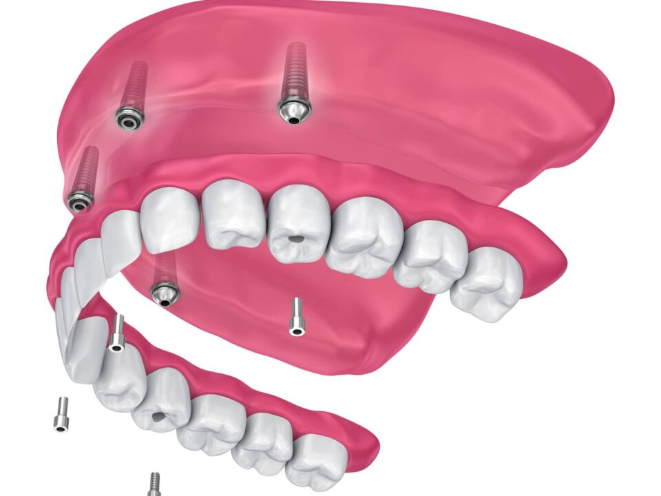 What Is a Full-Mouth Reconstruction and Who Needs One? 2 What Is a Full-Mouth Reconstruction and Who Needs One?