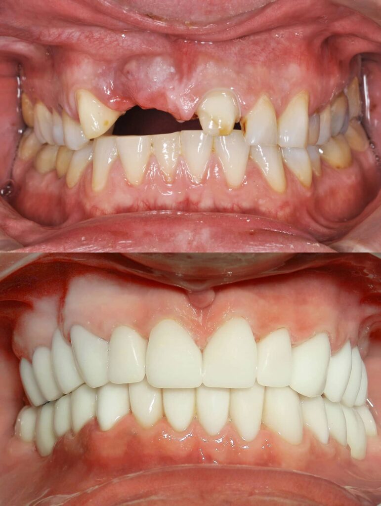 What Is a Full-Mouth Reconstruction and Who Needs One? 2 What Is a Full-Mouth Reconstruction and Who Needs One?