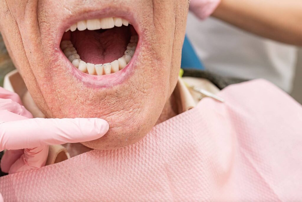 What Is a Full-Mouth Reconstruction and Who Needs One? 1 What Is a Full-Mouth Reconstruction and Who Needs One?