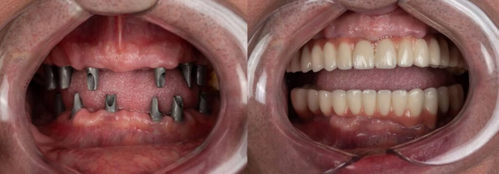 What Is a Full-Mouth Reconstruction and Who Needs One? 3 What Is a Full-Mouth Reconstruction and Who Needs One?