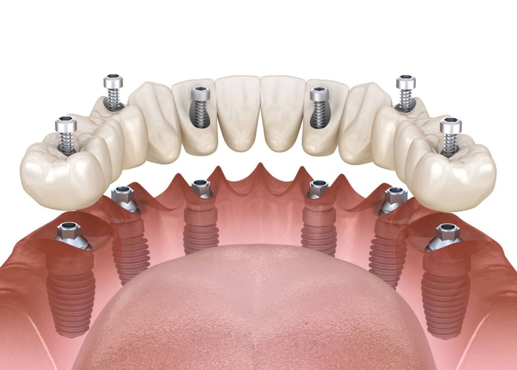 What Is a Full-Mouth Reconstruction and Who Needs One? 4 What Is a Full-Mouth Reconstruction and Who Needs One?