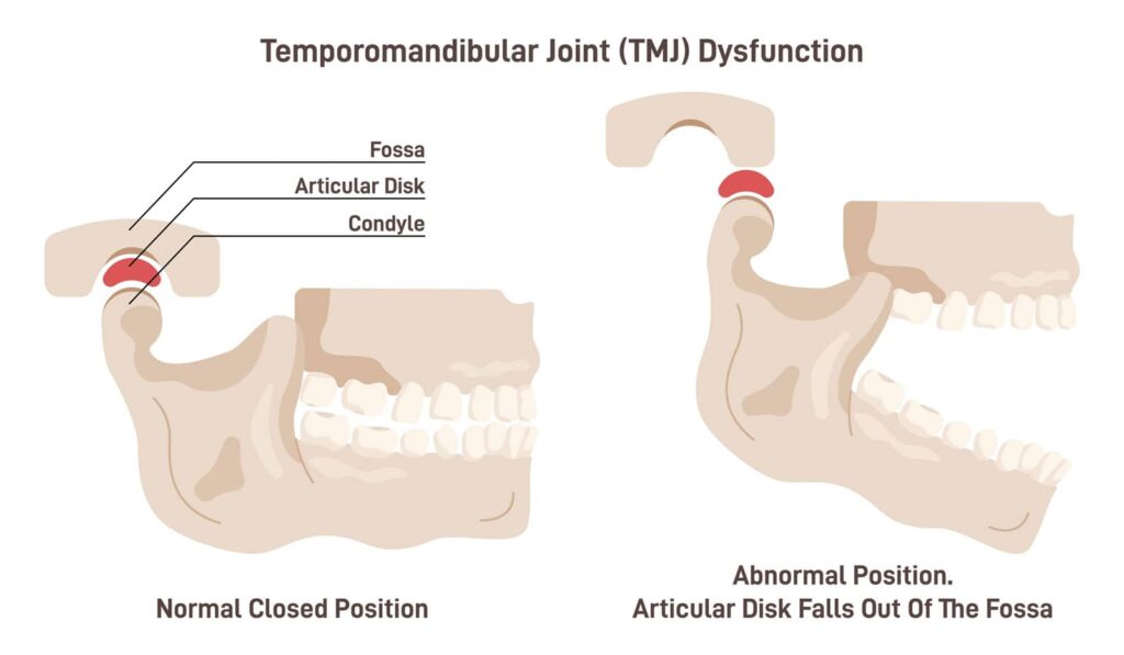 How to Cure TMJ Permanently: Insights from Orange County’s Top Holistic Dental Office 2 How to Cure TMJ Permanently: Insights from Orange County’s Top Holistic Dental Office