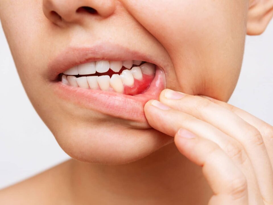 Natural Treatment for Periodontal Disease That Goes Beyond Brushing and Flossing