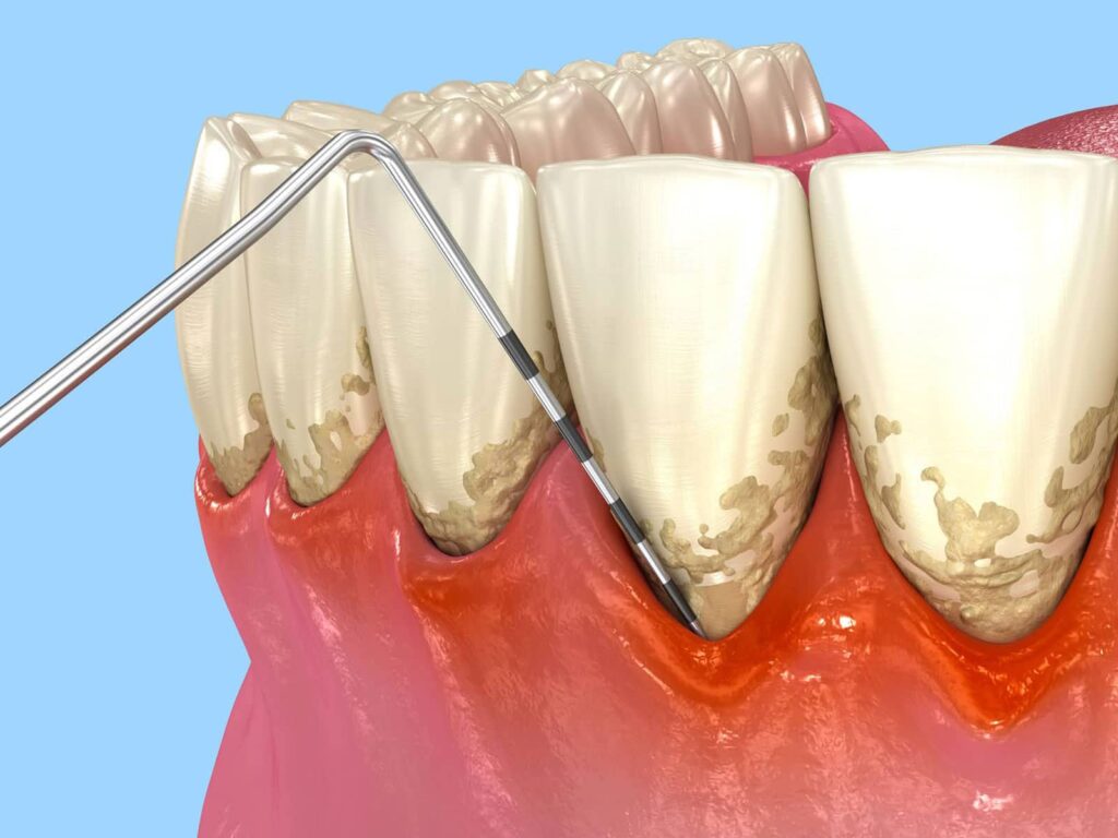 Natural Treatment for Periodontal Disease That Goes Beyond Brushing and Flossing 2 Natural Treatment for Periodontal Disease That Goes Beyond Brushing and Flossing