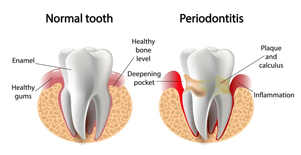 Natural Treatment for Periodontal Disease That Goes Beyond Brushing and Flossing 3 Natural Treatment for Periodontal Disease That Goes Beyond Brushing and Flossing