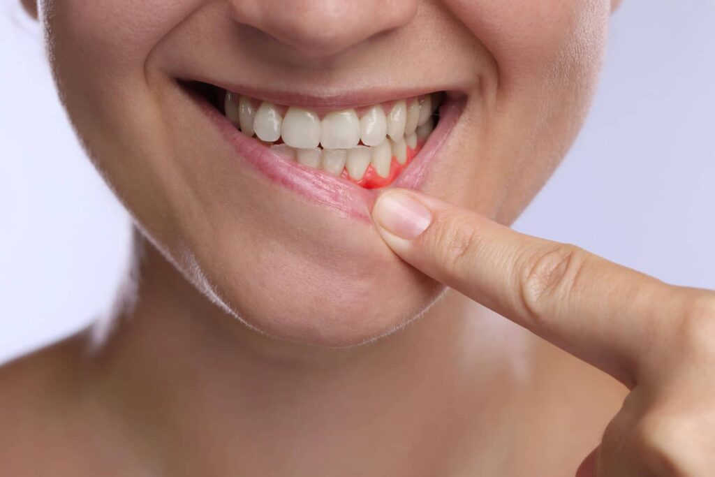 Natural Treatment for Periodontal Disease That Goes Beyond Brushing and Flossing 4 Natural Treatment for Periodontal Disease That Goes Beyond Brushing and Flossing