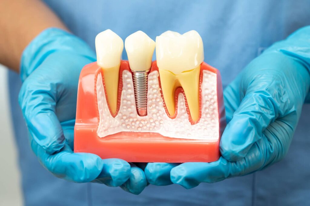 Why No Dairy After Dental Implant? And How Long Should You Actually Wait? 1 Why No Dairy After Dental Implant? And How Long Should You Actually Wait?