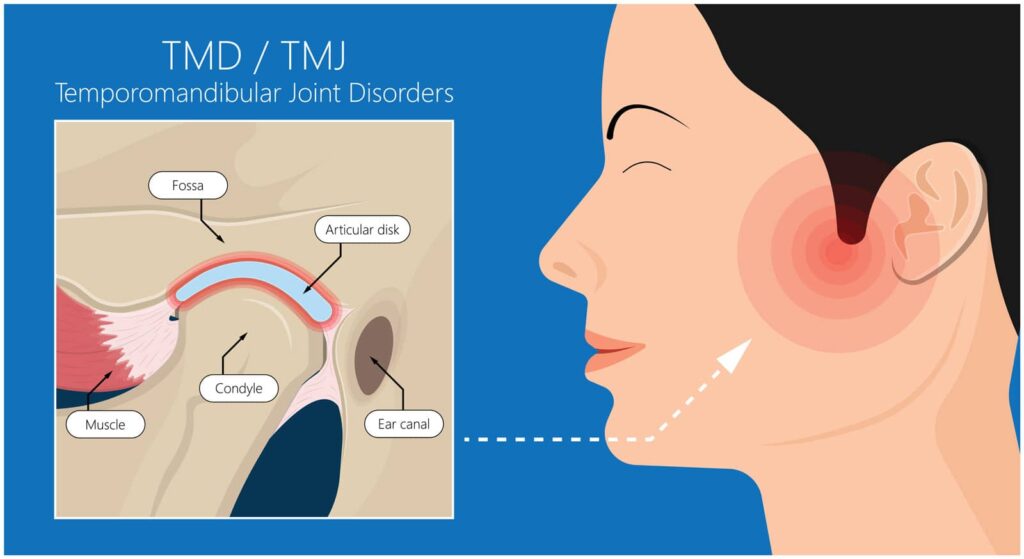 Could Your Jaw Be Causing Your Headaches? TMJ Signs to Watch For 3 Could Your Jaw Be Causing Your Headaches? TMJ Signs to Watch For