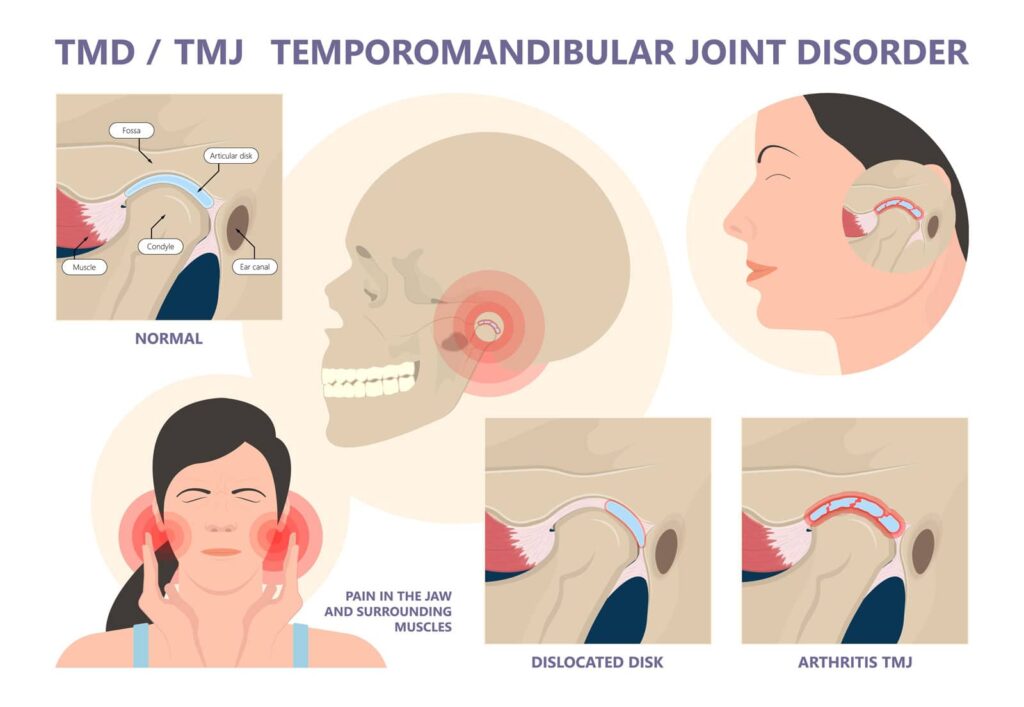 Could Your Jaw Be Causing Your Headaches? TMJ Signs to Watch For 1 Could Your Jaw Be Causing Your Headaches? TMJ Signs to Watch For