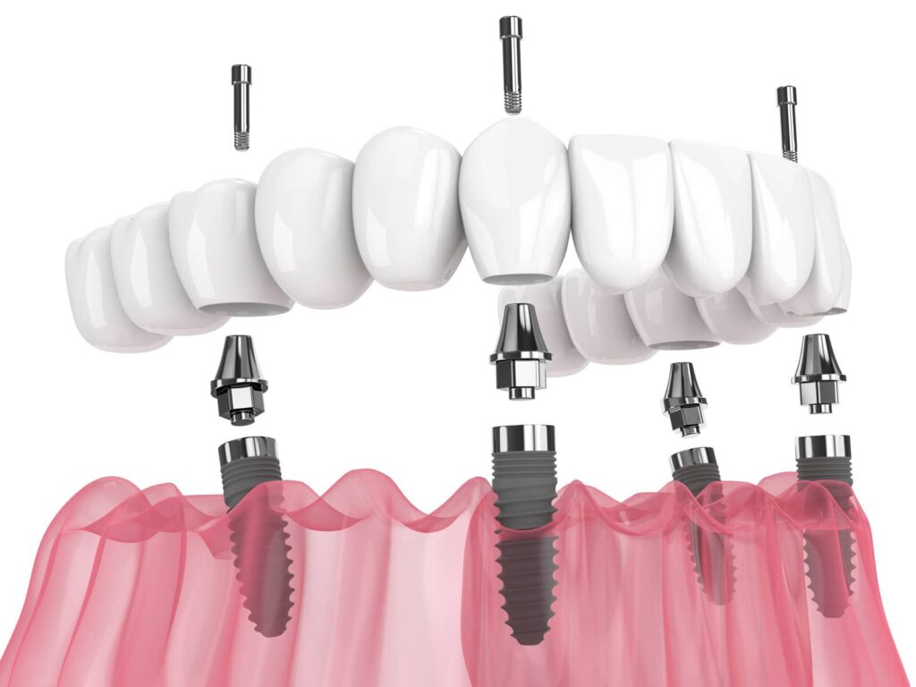 Will All-on-4 Implants Affect My Speech? A Complete Guide to All on 4 Dental Implants and Your Voice 2 Will All-on-4 Implants Affect My Speech? A Complete Guide to All on 4 Dental Implants and Your Voice