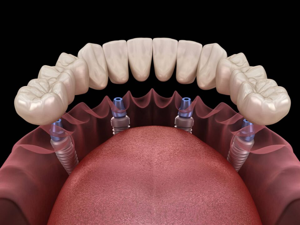 Will All-on-4 Implants Affect My Speech? A Complete Guide to All on 4 Dental Implants and Your Voice 6 Will All-on-4 Implants Affect My Speech? A Complete Guide to All on 4 Dental Implants and Your Voice