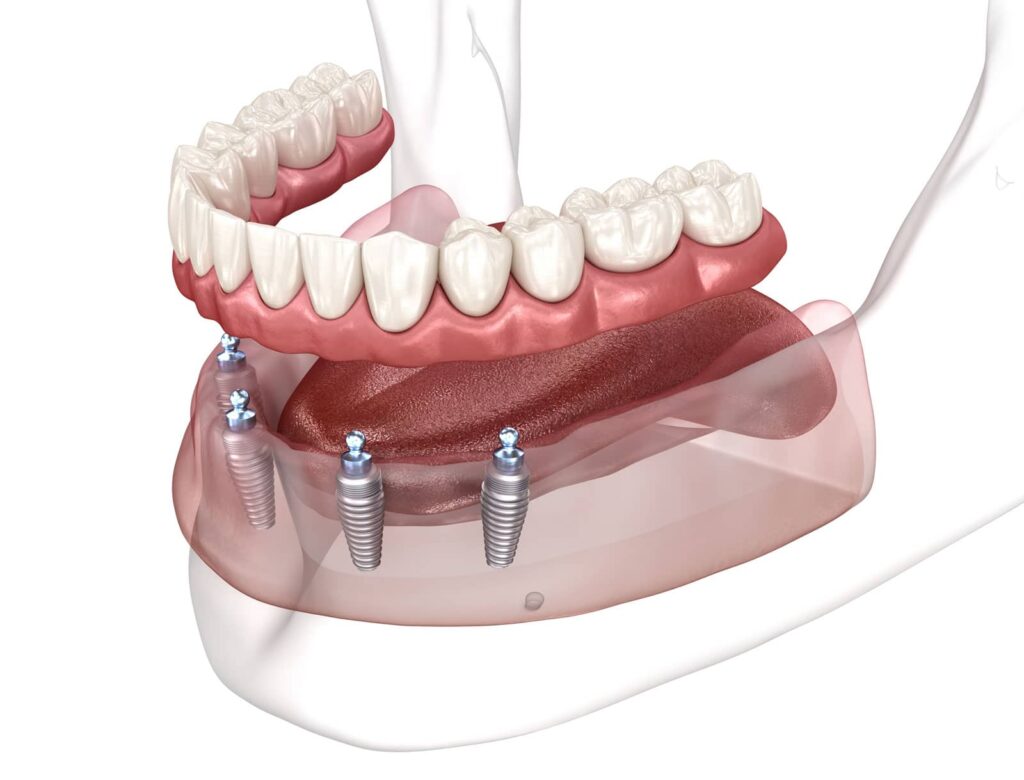 Will All-on-4 Implants Affect My Speech? A Complete Guide to All on 4 Dental Implants and Your Voice 1 Will All-on-4 Implants Affect My Speech? A Complete Guide to All on 4 Dental Implants and Your Voice