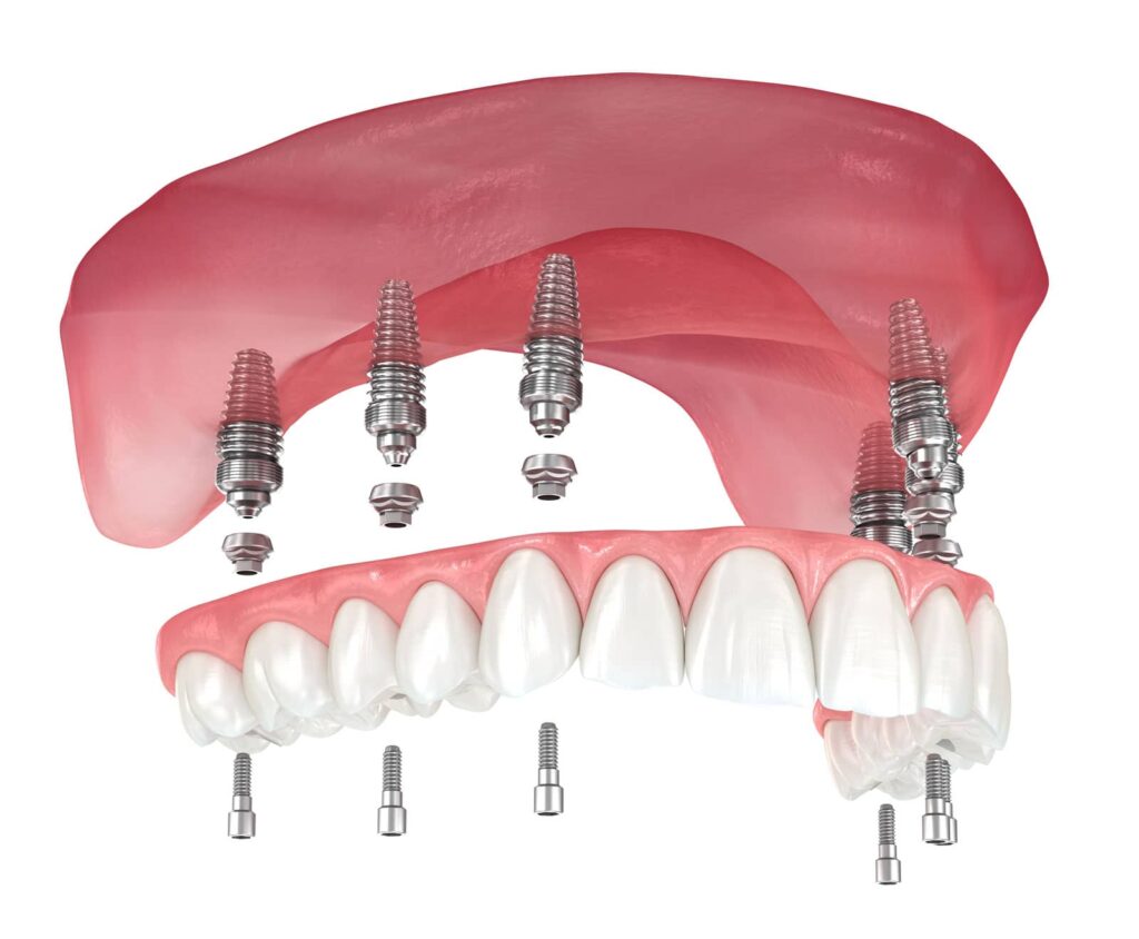 All-on-6 Dental Implants vs. Traditional Dentures: A Side-by-Side Comparison for Orange County Patients 1 All-on-6 Dental Implants vs. Traditional Dentures: A Side-by-Side Comparison for Orange County Patients