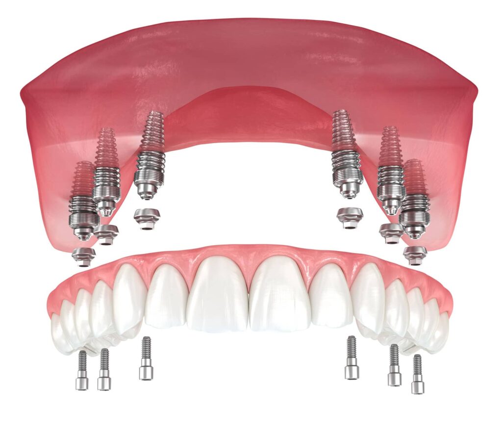 All-on-6 Dental Implants vs. Traditional Dentures: A Side-by-Side Comparison for Orange County Patients 3 All-on-6 Dental Implants vs. Traditional Dentures: A Side-by-Side Comparison for Orange County Patients