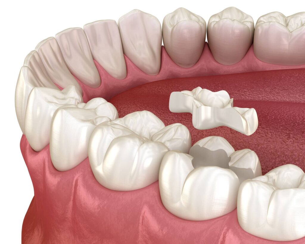 Dental Inlay Procedure: What to Expect, Start to Finish 1 Dental Inlay Procedure: What to Expect, Start to Finish
