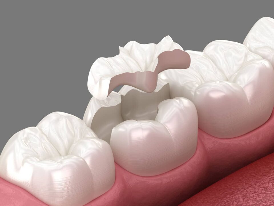 Dental Inlay Procedure: What to Expect, Start to Finish 2 Dental Inlay Procedure: What to Expect, Start to Finish