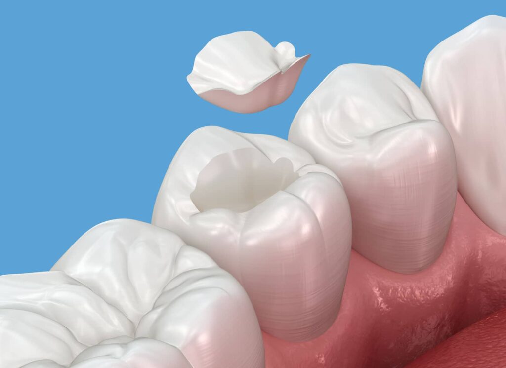 Dental Inlay Procedure: What to Expect, Start to Finish 2 Dental Inlay Procedure: What to Expect, Start to Finish