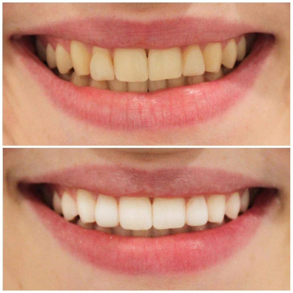 How to Whiten Teeth Safely: What Dentists Recommend 1 How to Whiten Teeth Safely: What Dentists Recommend