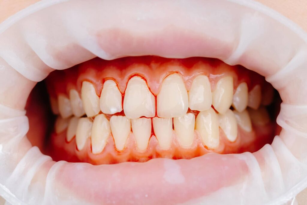Can Gum Disease Kill You? Risks, Warning Signs, and Prevention 3 Can Gum Disease Kill You? Risks, Warning Signs, and Prevention