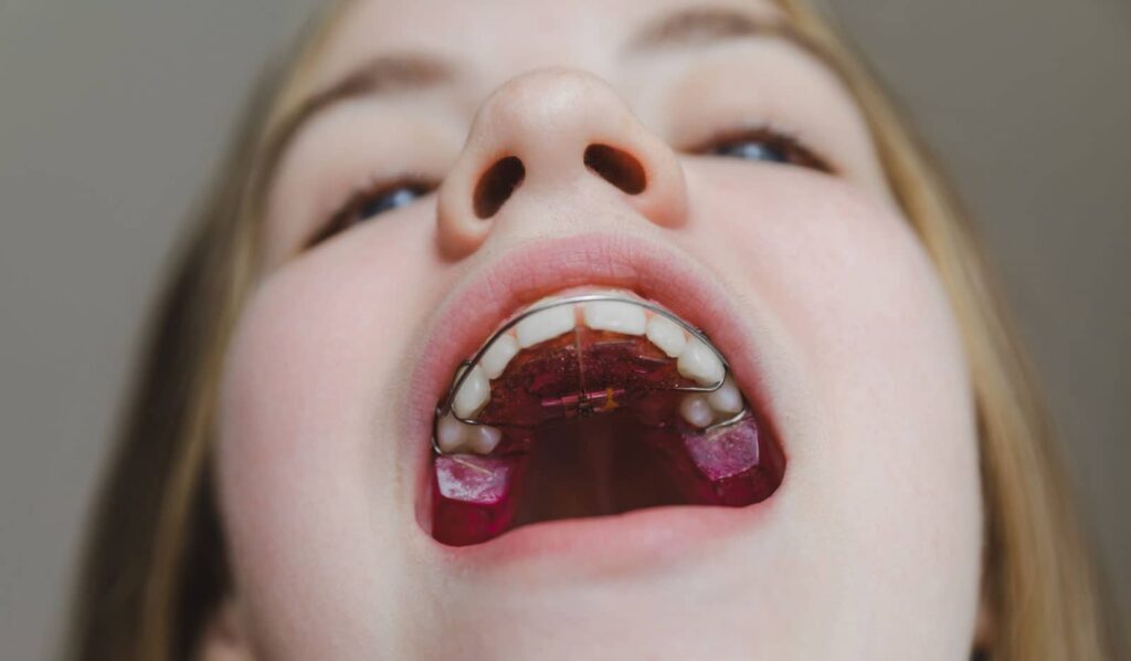 Common Orthodontic Appliances for Children, Teens, and Adults 2 Common Orthodontic Appliances for Children, Teens, and Adults