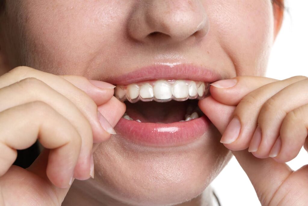 Common Orthodontic Appliances for Children, Teens, and Adults 4 Common Orthodontic Appliances for Children, Teens, and Adults