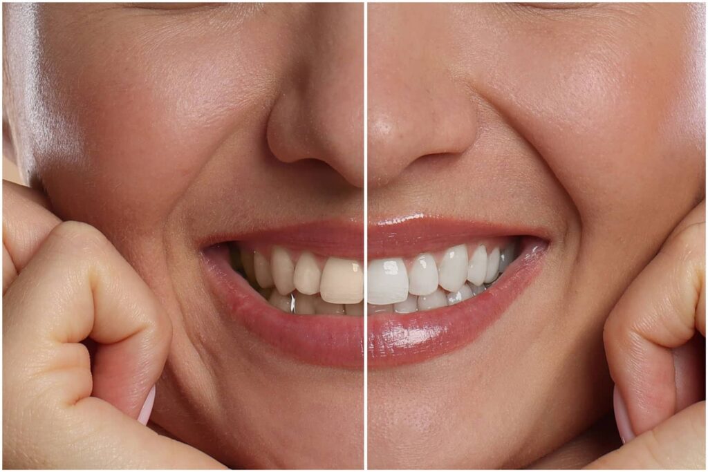 Cosmetic Dental Treatments: From Whitening to Veneers 1 Cosmetic Dental Treatments: From Whitening to Veneers