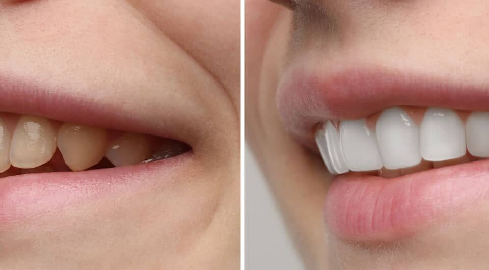 Do Porcelain Veneers Stain? What You Need to Know 6 Do Porcelain Veneers Stain? What You Need to Know