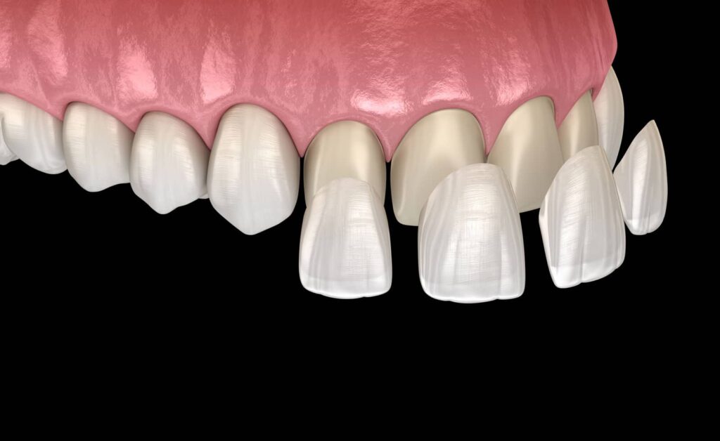 Do Porcelain Veneers Stain? What You Need to Know 1 Do Porcelain Veneers Stain? What You Need to Know