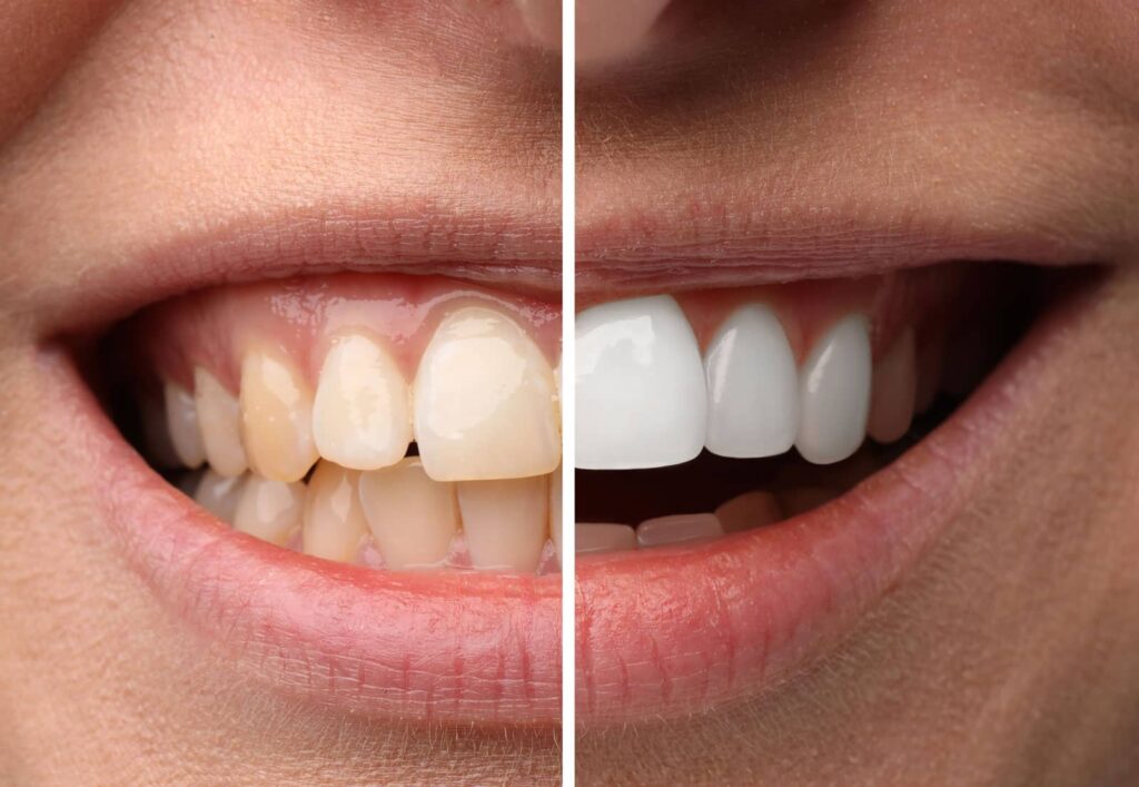 Do Porcelain Veneers Stain? What You Need to Know 2 Do Porcelain Veneers Stain? What You Need to Know