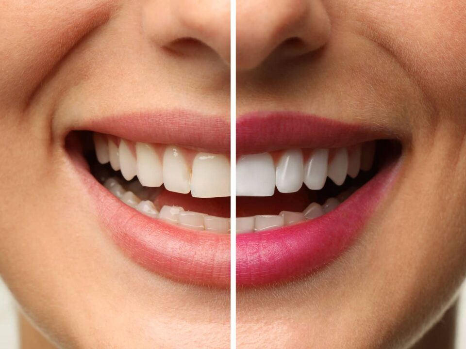 Can a Porcelain Crown Be Reshaped? A Biological Dentist's Approach to Adjustment Before Replacement 4 Can a Porcelain Crown Be Reshaped