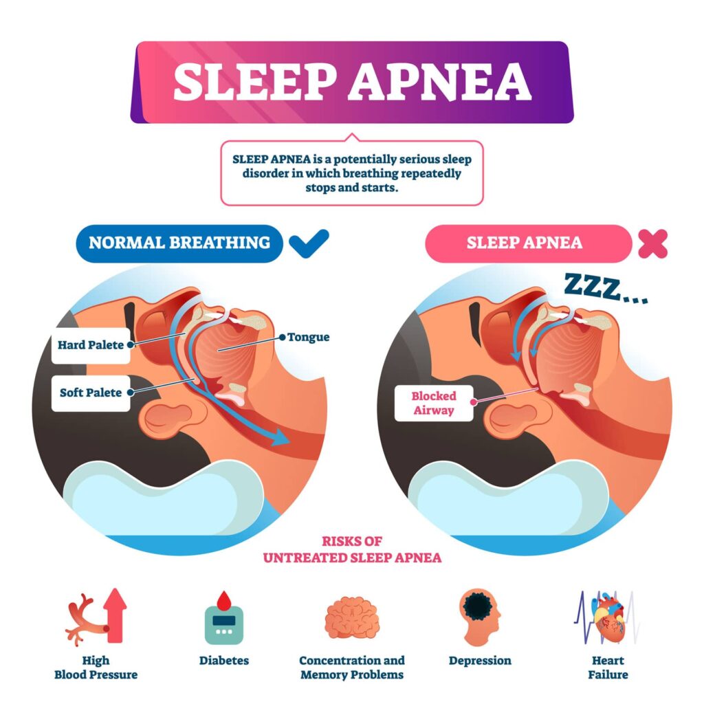 Is Snoring Sleep Apnea? How to Tell the Difference 1 Is Snoring Sleep Apnea? How to Tell the Difference